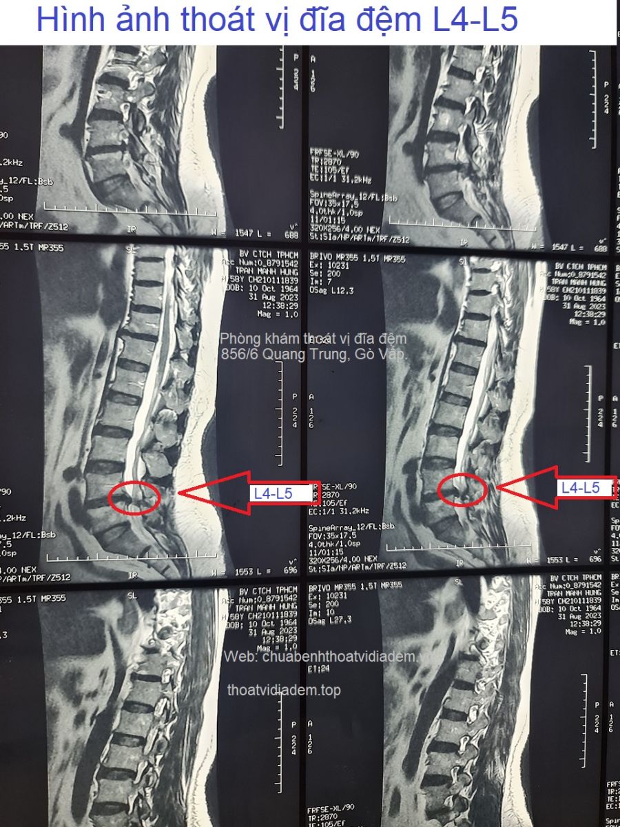Hình ảnh thoát vị đĩa đệm L4-L5